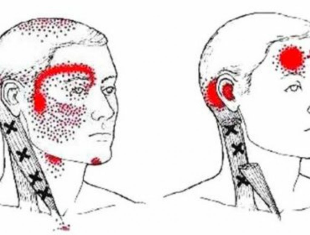 Migrañas
